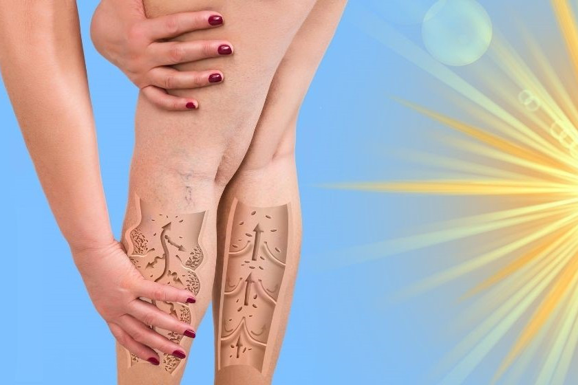 Wassereinlagerungen im Sommer - symbolisiert von dicken Frauenbeinen und Sonne